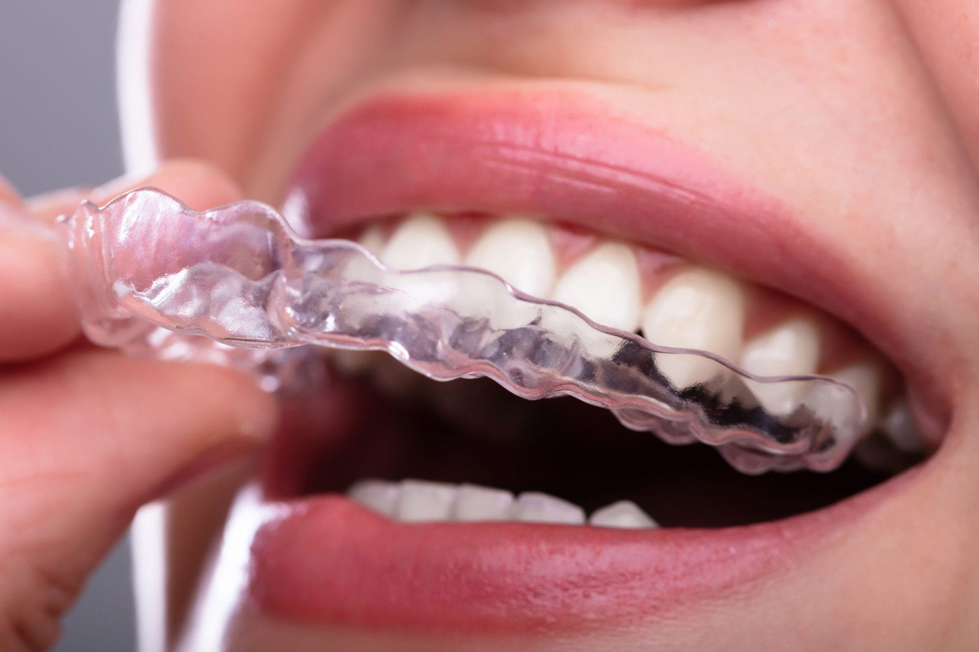 A close-up view of Candid clear dental aligners, showcasing their transparent and sleek design, poised to be placed over teeth.