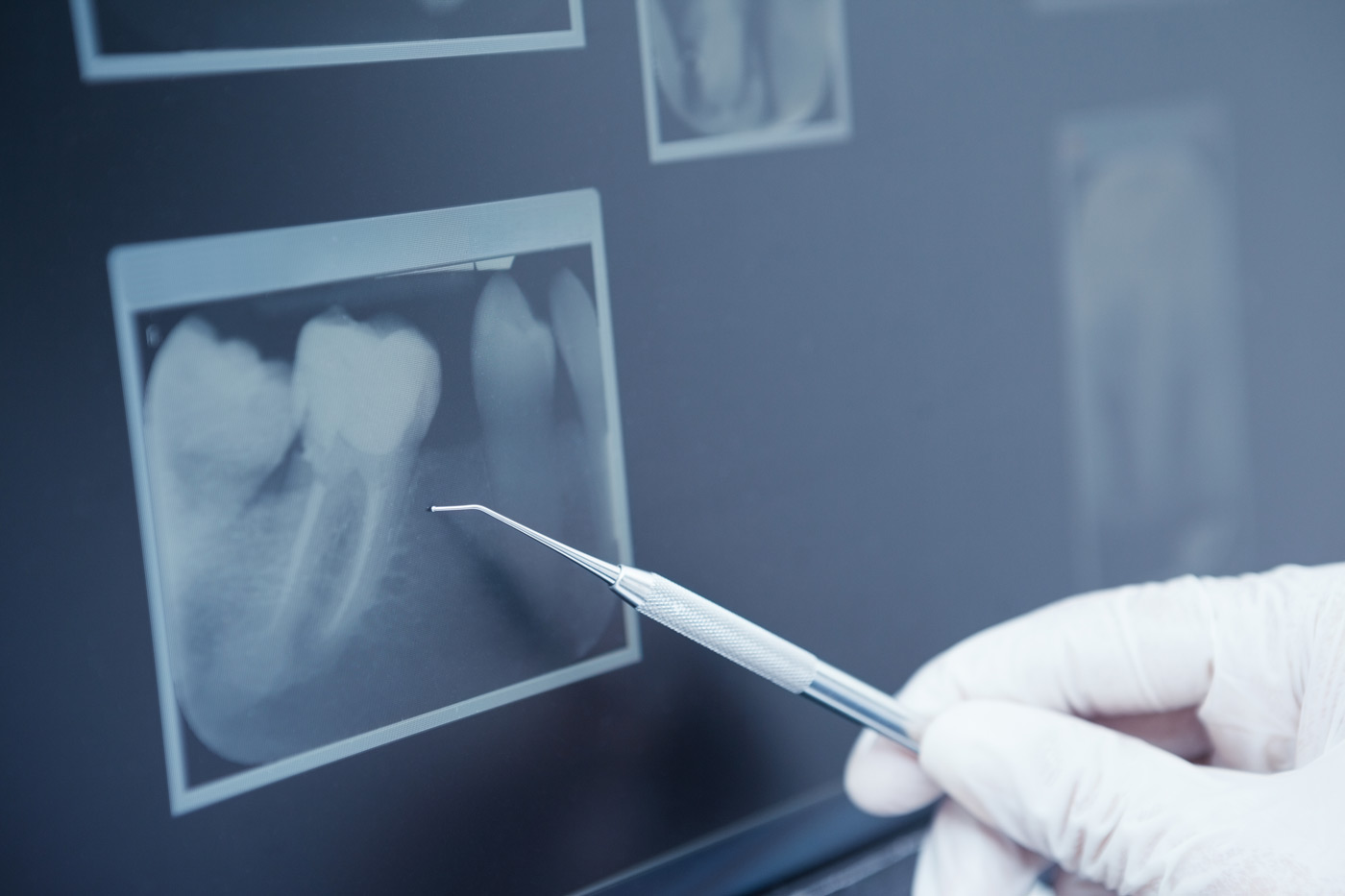 Dental X-rays displayed on a screen, showcasing detailed images of teeth structure.